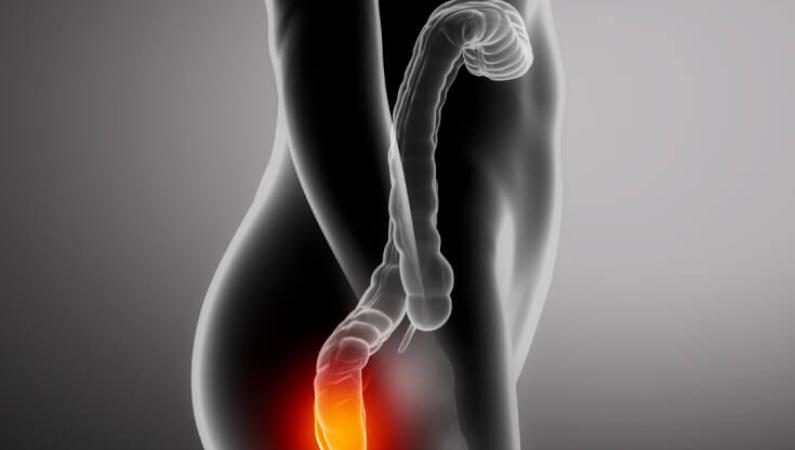 أعراض وعلاج البواسير أعراض وعلاج البواسير