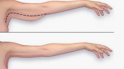 طرق طبيعية لإنقاص وزن الذراع