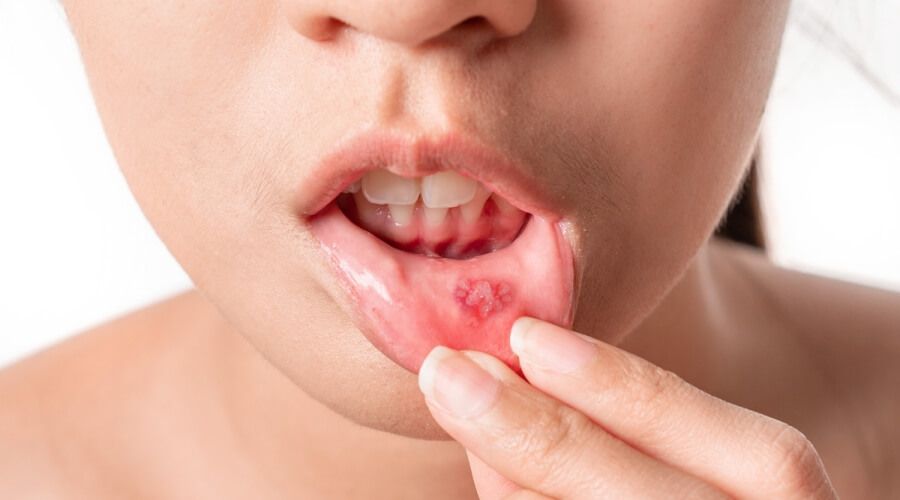 العلاج الفوري لتقرحات الفم