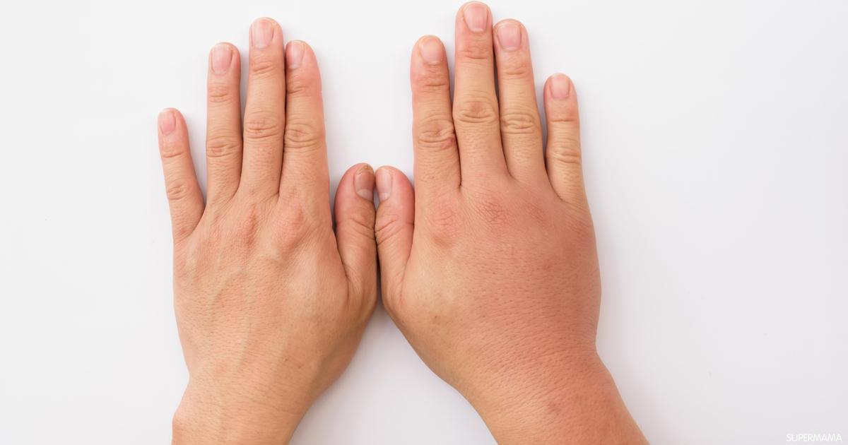 آلام الأعصاب في اليد اليمنى