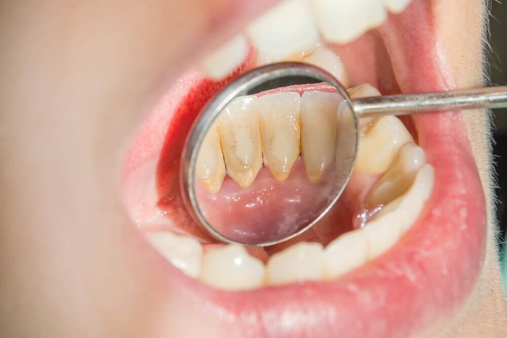 أطعمة لتبييض وإزالة اصفرار الأسنان