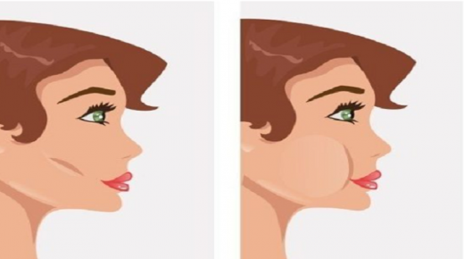 عملية دهون الخدين