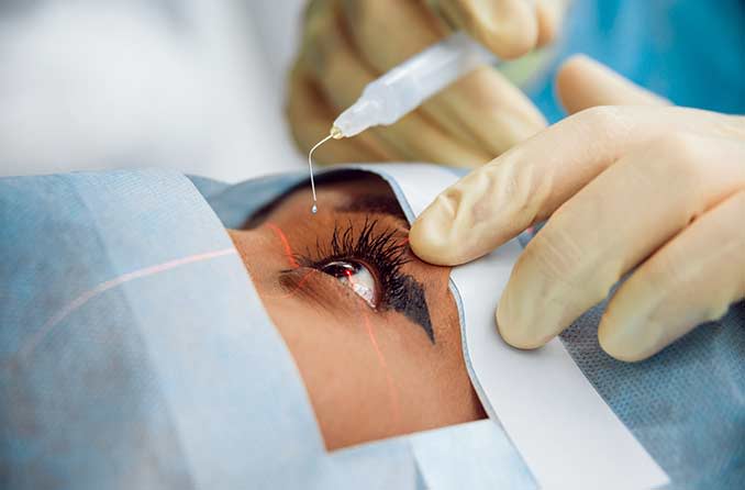 Hero Article Cataract Surgery   - موقع رموش