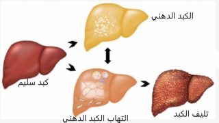 علاج الكبد الدهني بعدة طرق فورية وفعالة