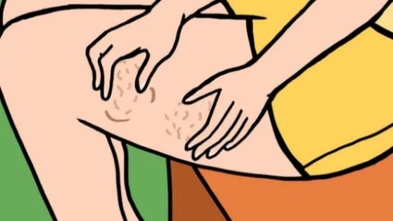 علاج السيلوليت