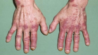 الذئبة الحمراء