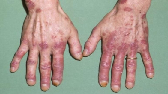 الذئبة الحمراء