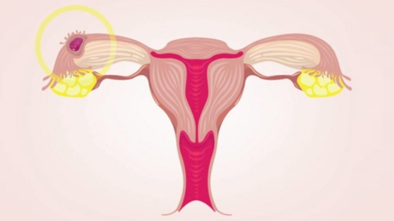 التبقيع أثناء الحمل