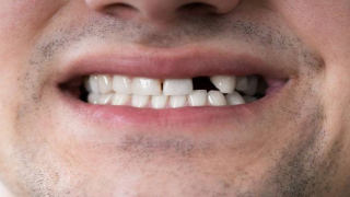 تفسير حلم سقوط الأسنان لابن سيرين