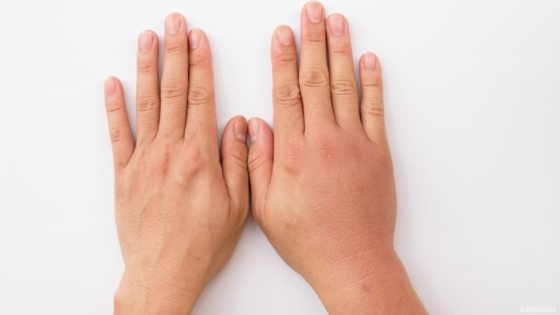 آلام الأعصاب في اليد اليمنى