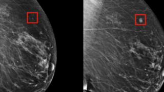 الثدي الاصطناعي