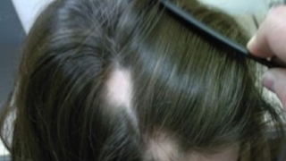 داء الثعلبة عند الأطفال