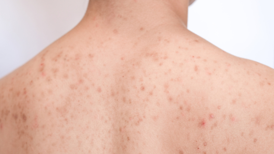 أنواع الحساسية الجلدية