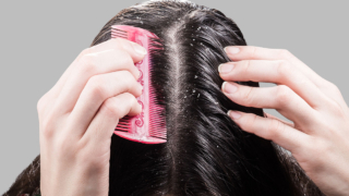 علاج قشرة الرأس