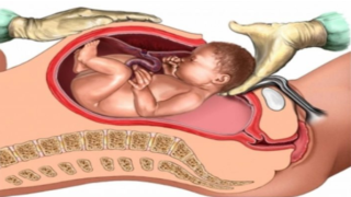 العلاج السريع للولادة القيصرية