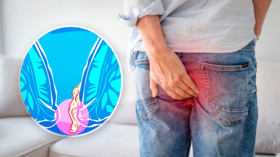 الحكة الشرجية