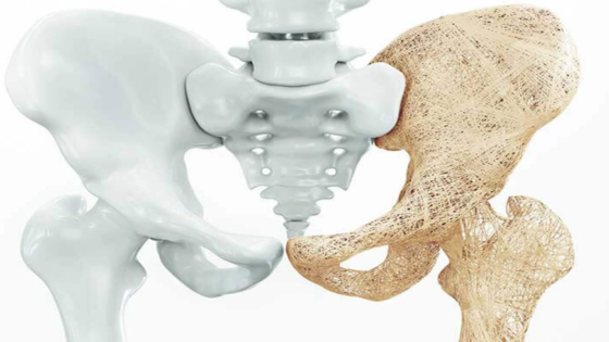 هشاشة العظام