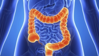 متلازمة القولون العصبي