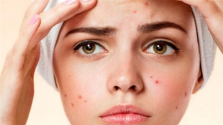 علاج حب الشباب