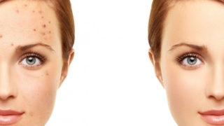 ظهور حبوب الشباب