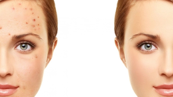 ظهور حبوب الشباب