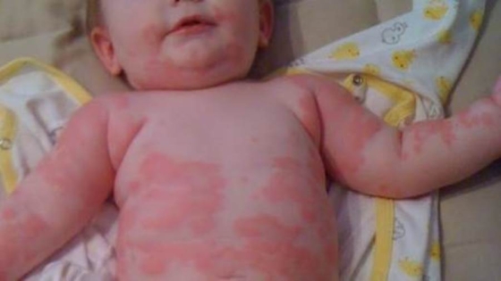 علاج حساسية البنسلين