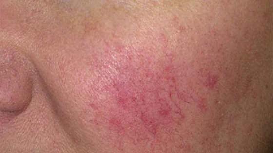 علاج حساسية الوجه بالمواد الطبيعية