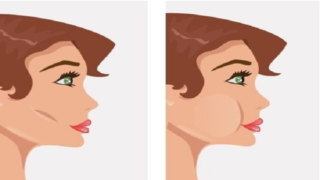 عملية دهون الخدين
