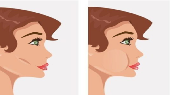 عملية دهون الخدين