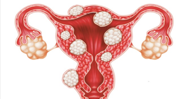 أعراض سرطان المبيض
