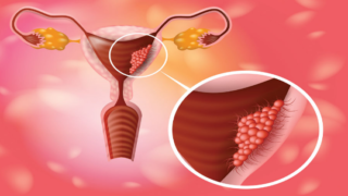 العقم عند النساء