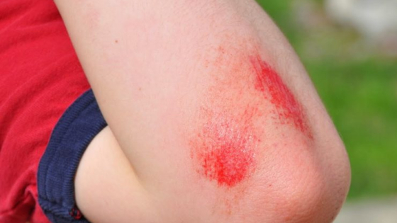 ما هي أفضل طريقة لتضميد جروح الأطفال؟