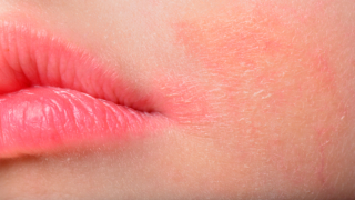 ما هي اكزيما الجلد