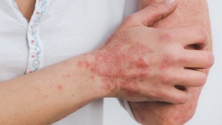 القوباء المنطقية