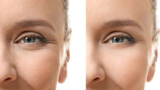 عملية رأب الجفن