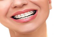 ما هو جسر الأسنان و أهم خطواته
