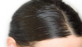 علاج قشرة الشعر الدهني