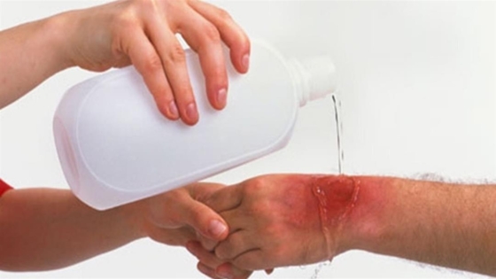 الحروق السطحية