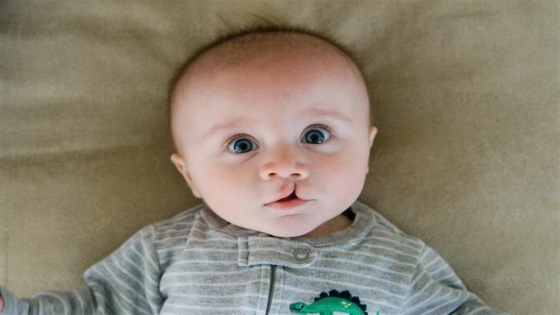 عملية الشفة الارنبية