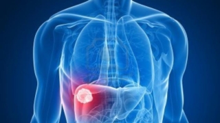 الكبد الدهني الكحولي