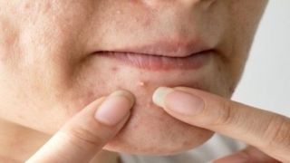 ظهور البثور