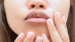 تقشر الشفاه