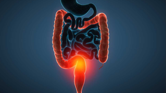 التهاب المستقيم