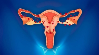 أكياس المبيض