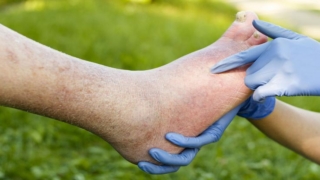 مرض البري بري