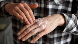 مرض الصدفية