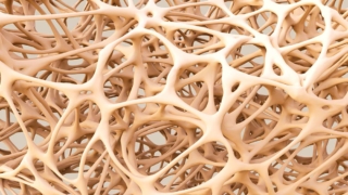 علاج هشاشة العظام