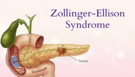 ما هي متلازمة زولينجر إليسون و أهم أعراضها