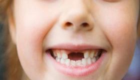 5 نصائح غذائية لمنع تسوس الأسنان عند الأطفال