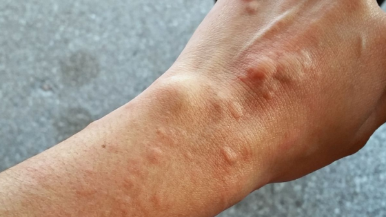 داء الشعريات المبوغة